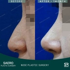 نتائج تجميل الأنف قبل وبعد في SAERO Plastic Surgery، شكل أنف محسّن بعد شهر