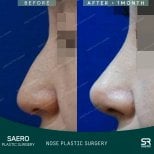 نتائج تجميل الأنف قبل وبعد في SAERO Plastic Surgery، شكل أنف محسّن بعد شهر