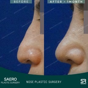 نتائج تجميل الأنف قبل وبعد في SAERO Plastic Surgery، تحسين شكل الأنف بعد شهر