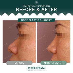 نتائج عملية تجميل الأنف قبل وبعد في SAERO Plastic Surgery، تحسين شكل الأنف بعد 3 أشهر