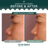 نتائج عملية تجميل الأنف قبل وبعد في SAERO Plastic Surgery، تحسين شكل الأنف بعد 3 أشهر