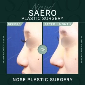 نتائج تجميل الأنف قبل وبعد في SAERO Plastic Surgery، تحسين شكل الأنف خلال شهر