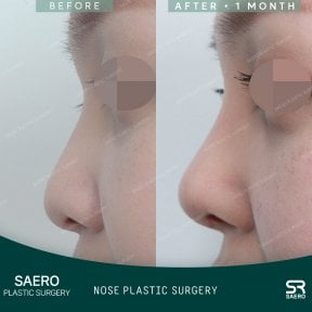 نتائج تجميل الأنف قبل وبعد في SAERO Plastic Surgery، تحسين شكل الأنف بعد شهر