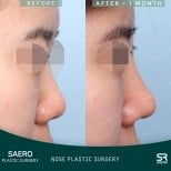نتائج عملية تجميل الأنف في SAERO Plastic Surgery قبل وبعد، تغيير شكل الأنف بعد شهر