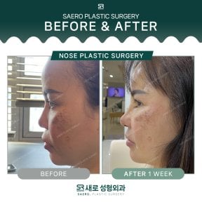 نتائج تجميل الأنف قبل وبعد في SAERO Plastic Surgery، إعادة تشكيل الأنف بعد أسبوع
