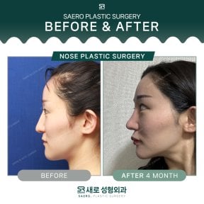 نتائج تجميل الأنف قبل وبعد في SAERO Plastic Surgery، تحسين شكل الأنف خلال 4 أشهر