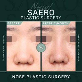نتائج تجميل الأنف قبل وبعد في SAERO Plastic Surgery، شكل أنف محسّن بعد شهرين