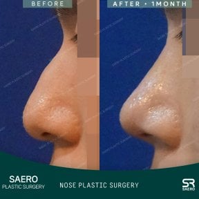 نتائج تجميل الأنف بالأوستيوتومي قبل وبعد في SAERO Plastic Surgery، تحسين شكل الأنف