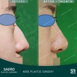 نتائج تجميل الأنف بالأوستيوتومي قبل وبعد في SAERO Plastic Surgery، تحسين شكل الأنف
