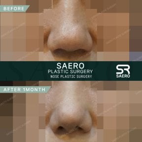 نتيجة تجميل الأنف بالأوستيوتومي قبل وبعد شهر في عيادة SAERO لجراحة التجميل