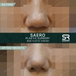 نتيجة تجميل الأنف بالأوستيوتومي قبل وبعد شهر في عيادة SAERO لجراحة التجميل