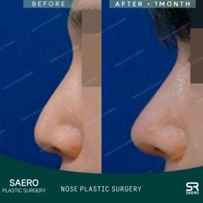 نتائج رأب الأنف بالأوستيوتومي قبل وبعد في SAERO Plastic Surgery، تحسين شكل الأنف