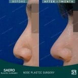 نتائج رأب الأنف بالأوستيوتومي قبل وبعد في SAERO Plastic Surgery، تحسين شكل الأنف