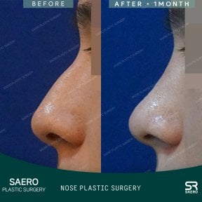 نتائج رأب الأنف بالأوستيوتومي قبل وبعد في SAERO Plastic Surgery، تحسين شكل الأنف