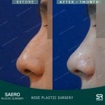 نتائج رأب الأنف بالأوستيوتومي قبل وبعد في SAERO Plastic Surgery، تحسين شكل الأنف