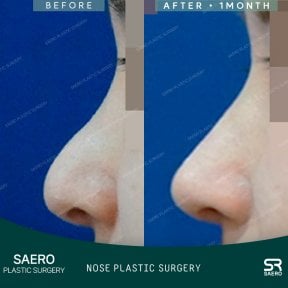 نتيجة تجميل الأنف بالأوستيوتومي قبل وبعد في SAERO Plastic Surgery، تحسين شكل الأنف
