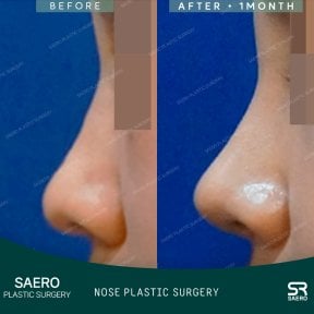 نتائج تجميل الأنف بالأوستيوتومي قبل وبعد في SAERO Plastic Surgery، تحسين شكل الأنف