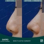 نتائج تجميل الأنف بالأوستيوتومي قبل وبعد في SAERO Plastic Surgery، تحسين شكل الأنف