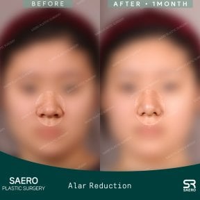 نتائج تصغير الأرنبة قبل وبعد في SAERO Plastic Surgery، تغيير واضح لشكل الأنف