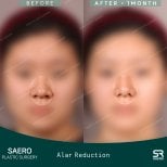 نتائج تصغير الأرنبة قبل وبعد في SAERO Plastic Surgery، تغيير واضح لشكل الأنف