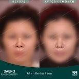 نتائج تصغير فتحات الأنف قبل وبعد في SAERO Plastic Surgery، تغيير شكل الأنف