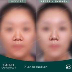 نتائج تصغير جناح الأنف قبل وبعد في SAERO Plastic Surgery، تحسين شكل الأنف
