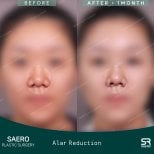 نتائج تصغير جناح الأنف قبل وبعد في SAERO Plastic Surgery، تحسين شكل الأنف