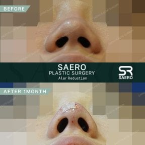 نتائج تصغير جناح الأنف قبل وبعد في SAERO Plastic Surgery بعد شهر واحد