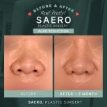 نتائج قبل وبعد تصغير فتحات الأنف في SAERO Plastic Surgery، تقليل عرض الأنف