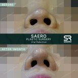 نتائج قبل وبعد تصغير الأرنبة في SAERO Plastic Surgery، تضييق فتحات الأنف