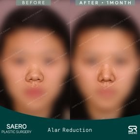 نتائج تصغير فتحات الأنف قبل وبعد في SAERO Plastic Surgery مع تغيير واضح للأنف