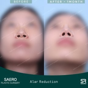 قبل وبعد تصغير الأرنبة في SAERO Plastic Surgery، نتيجة تحسين فتحات الأنف واضحة