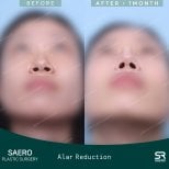 قبل وبعد تصغير الأرنبة في SAERO Plastic Surgery، نتيجة تحسين فتحات الأنف واضحة