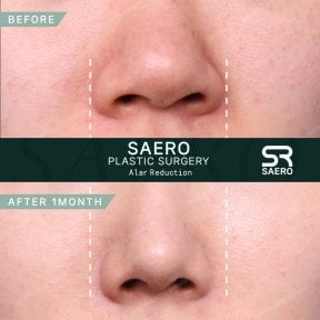 نتائج تصغير جناح الأنف قبل وبعد في SAERO Plastic Surgery بعد شهر واحد من الجراحة