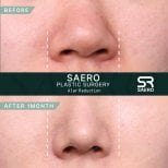 نتائج تصغير جناح الأنف قبل وبعد في SAERO Plastic Surgery بعد شهر واحد من الجراحة