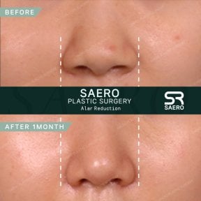 قبل وبعد تصغير جناح الأنف في SAERO Plastic Surgery، تحسين واضح في شكل الأنف