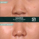 قبل وبعد تصغير جناح الأنف في SAERO Plastic Surgery، تحسين واضح في شكل الأنف