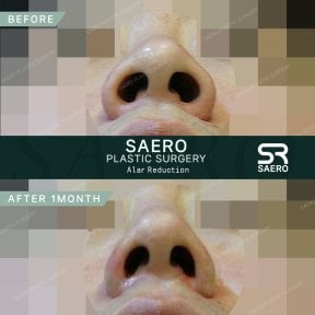 نتائج تصغير جناح الأنف قبل وبعد في SAERO Plastic Surgery بعد شهر واحد