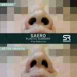 نتائج تصغير جناح الأنف قبل وبعد في SAERO Plastic Surgery بعد شهر واحد