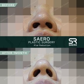 نتائج تصغير فتحات الأنف قبل وبعد في SAERO Plastic Surgery بعد شهر واحد