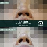 نتائج تصغير فتحات الأنف قبل وبعد في SAERO Plastic Surgery بعد شهر واحد