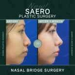 Результати до і після операції на переніссі в SAERO Plastic Surgery, покращений профіль носа