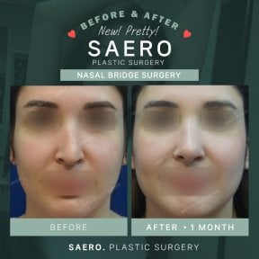Результати до і після операції на спинці носа в SAERO Plastic Surgery, покращена форма носа