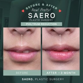 نتائج تصغير المسافة بين الأنف والشفة قبل وبعد في SAERO Plastic Surgery، تحسين الشفاه