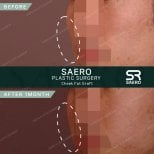نتائج حقن دهون الخد قبل وبعد في SAERO Plastic Surgery، خدود ممتلئة بعد شهر