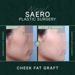 نتائج حقن دهون الخد قبل وبعد في SAERO Plastic Surgery، زيادة امتلاء الوجه