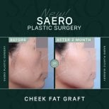 نتائج حقن دهون الخد قبل وبعد في SAERO Plastic Surgery، زيادة امتلاء الوجه