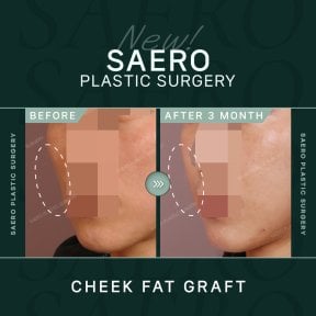نتائج حقن دهون الخد قبل وبعد في SAERO Plastic Surgery، امتلاء الخدين بعد 3 أشهر