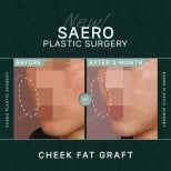 نتائج حقن دهون الخد قبل وبعد في SAERO Plastic Surgery، امتلاء الخدين بعد 3 أشهر