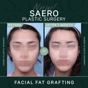 نتائج حقن الدهون للوجه في SAERO Plastic Surgery، زيادة واضحة في الامتلاء